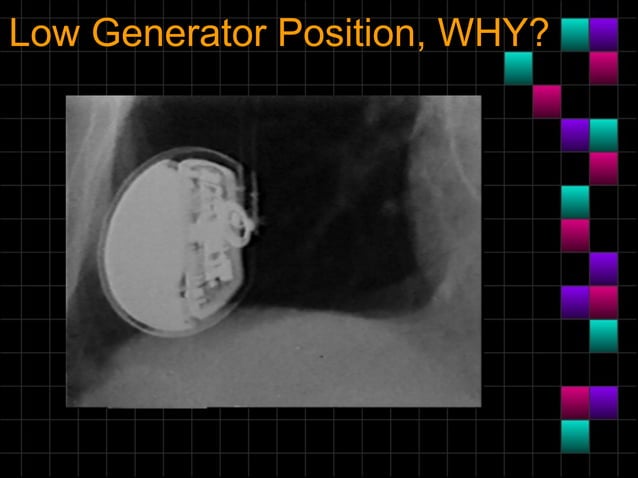 Pacemaker radiologyanintroduction | PPT