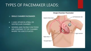 Single Lead Pacmaker Pace makers | PPTX