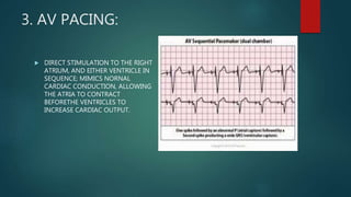 Pacing Definition Pacemaker Pace makers | PPTX