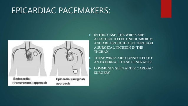 Pace makers