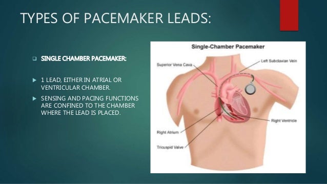 Single chamber vs dual chamber pacemaker