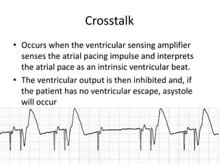 Crosstalk
• Occurs when the ventricular sensing amplifier
senses the atrial pacing impulse and interprets
the atrial pace as an intrinsic ventricular beat.
• The ventricular output is then inhibited and, if
the patient has no ventricular escape, asystole
will occur
 