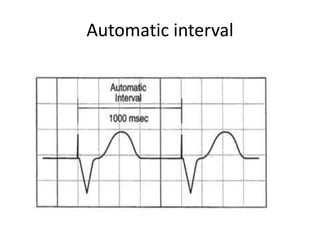 Automatic interval
 