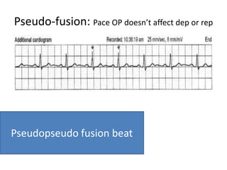 Pseudo-fusion: Pace OP doesn’t affect dep or rep
Pseudopseudo fusion beat
 