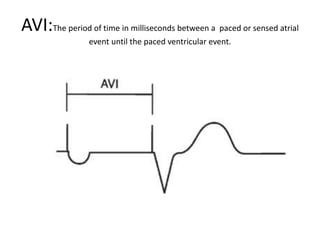 AVI:The period of time in milliseconds between a paced or sensed atrial
event until the paced ventricular event.
 