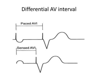 Differential AV interval
 