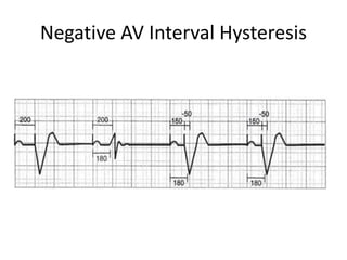 Negative AV Interval Hysteresis
 