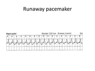 Runaway pacemaker
 
