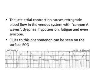 • The late atrial contraction causes retrograde
blood flow in the venous system with “cannon A
waves”, dyspnea, hypotension, fatigue and even
syncope.
• Clues to this phenomenon can be seen on the
surface ECG
 