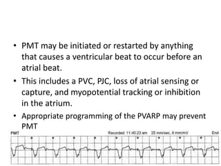 • PMT may be initiated or restarted by anything
that causes a ventricular beat to occur before an
atrial beat.
• This includes a PVC, PJC, loss of atrial sensing or
capture, and myopotential tracking or inhibition
in the atrium.
• Appropriate programming of the PVARP may prevent
PMT
 
