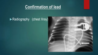 Lead Numbers Radiology Pacemakers | PPTX