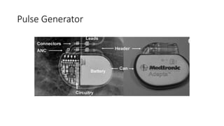 Moderne Pacemaker General Overview of Modern Cardiac Pacemakers | PPTX