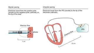 Moderne Pacemaker General Overview of Modern Cardiac Pacemakers | PPTX