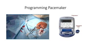 General Overview of Modern Cardiac Pacemakers | PPTX