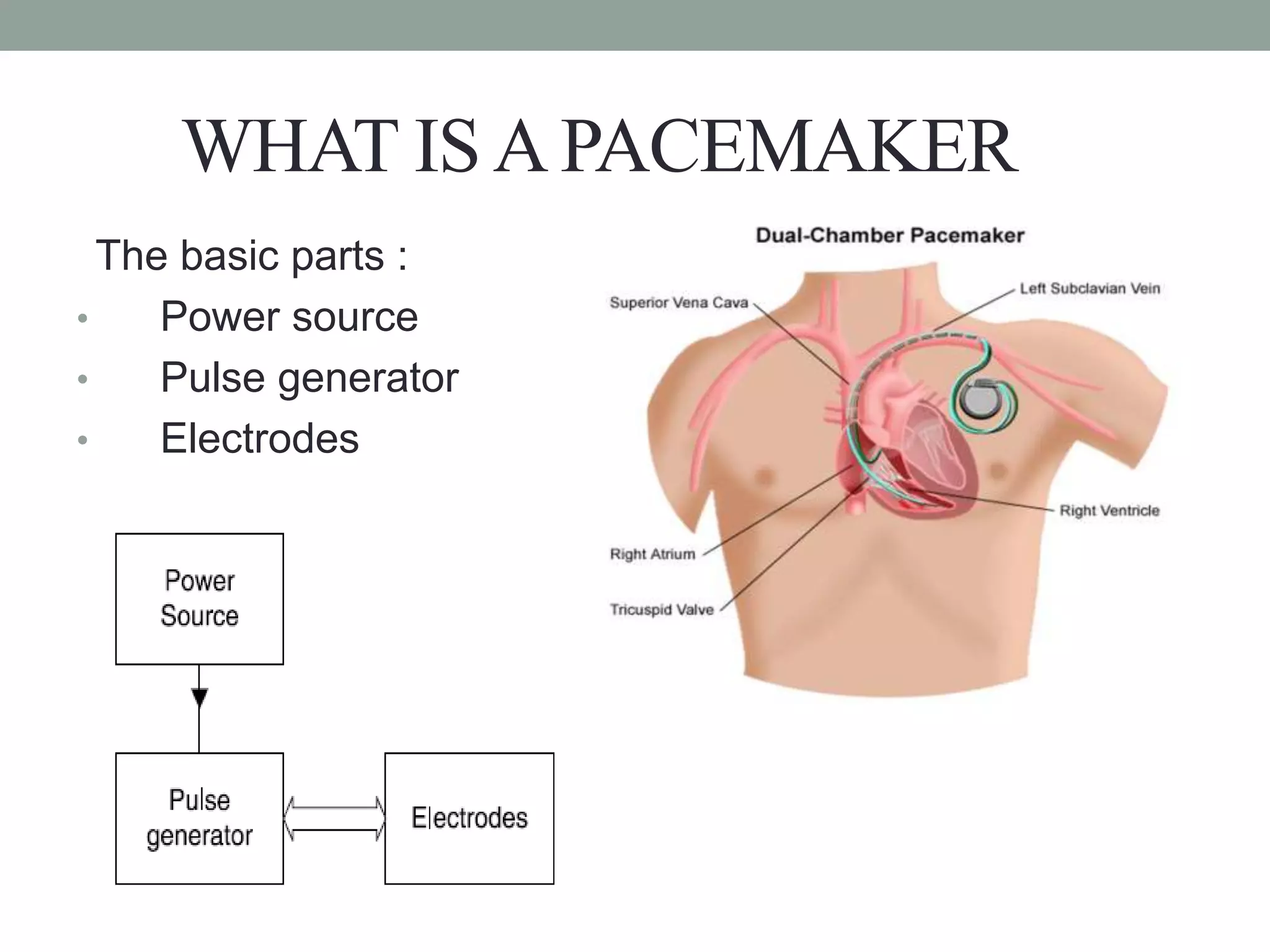 WHAT ISAPACEMAKER
The basic parts :
• Power source
• Pulse generator
• Electrodes