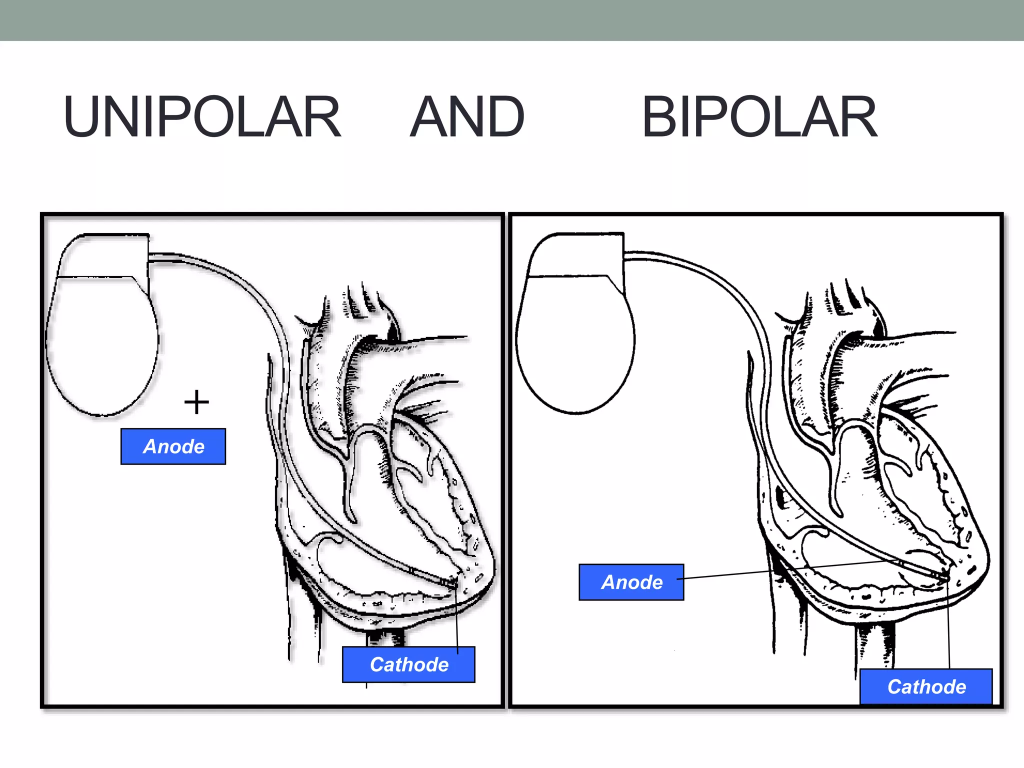 UNIPOLAR AND BIPOLAR
•
+
Anode
Cathode
Anode
Cathode