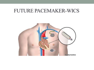 Pacemakers ppt1 | PPTX