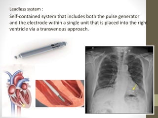 Cardiac Pacemakers | PPT