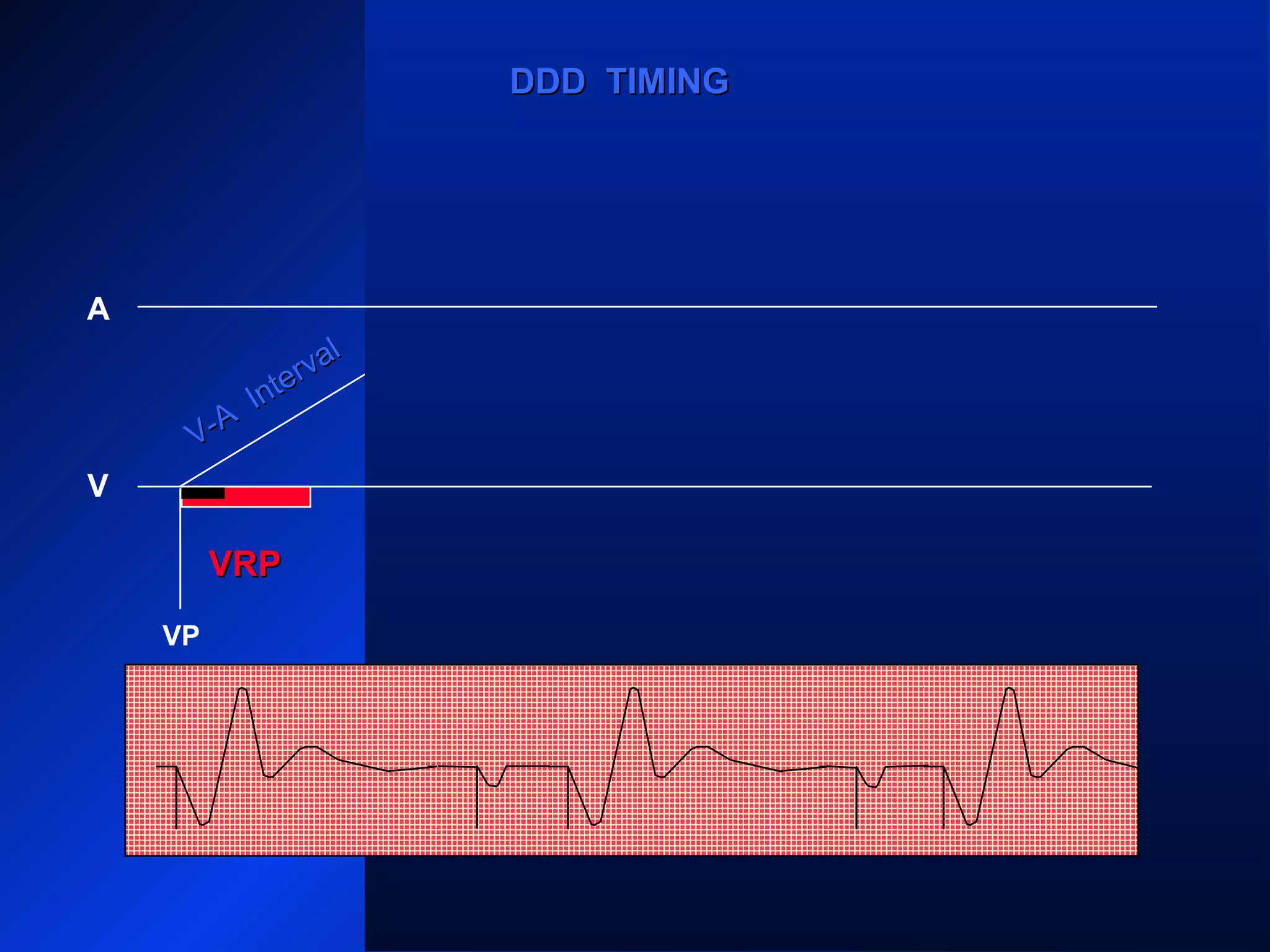 VP VP VP
AP AP
V
A
V-A
Interval
V-A
Interval
DDD TIMINGDDD TIMING
VRPVRP
 