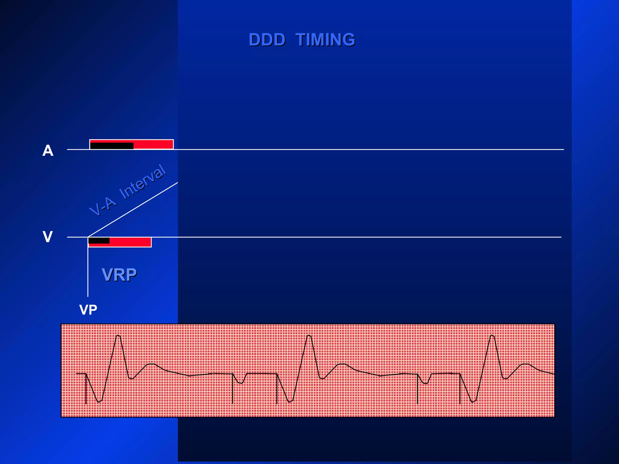 VP
A
V
PVARPPVARP
AP
VP
DDD TIMINGDDD TIMING
V-A
Interval
V-A
Interval
VRPVRP
 