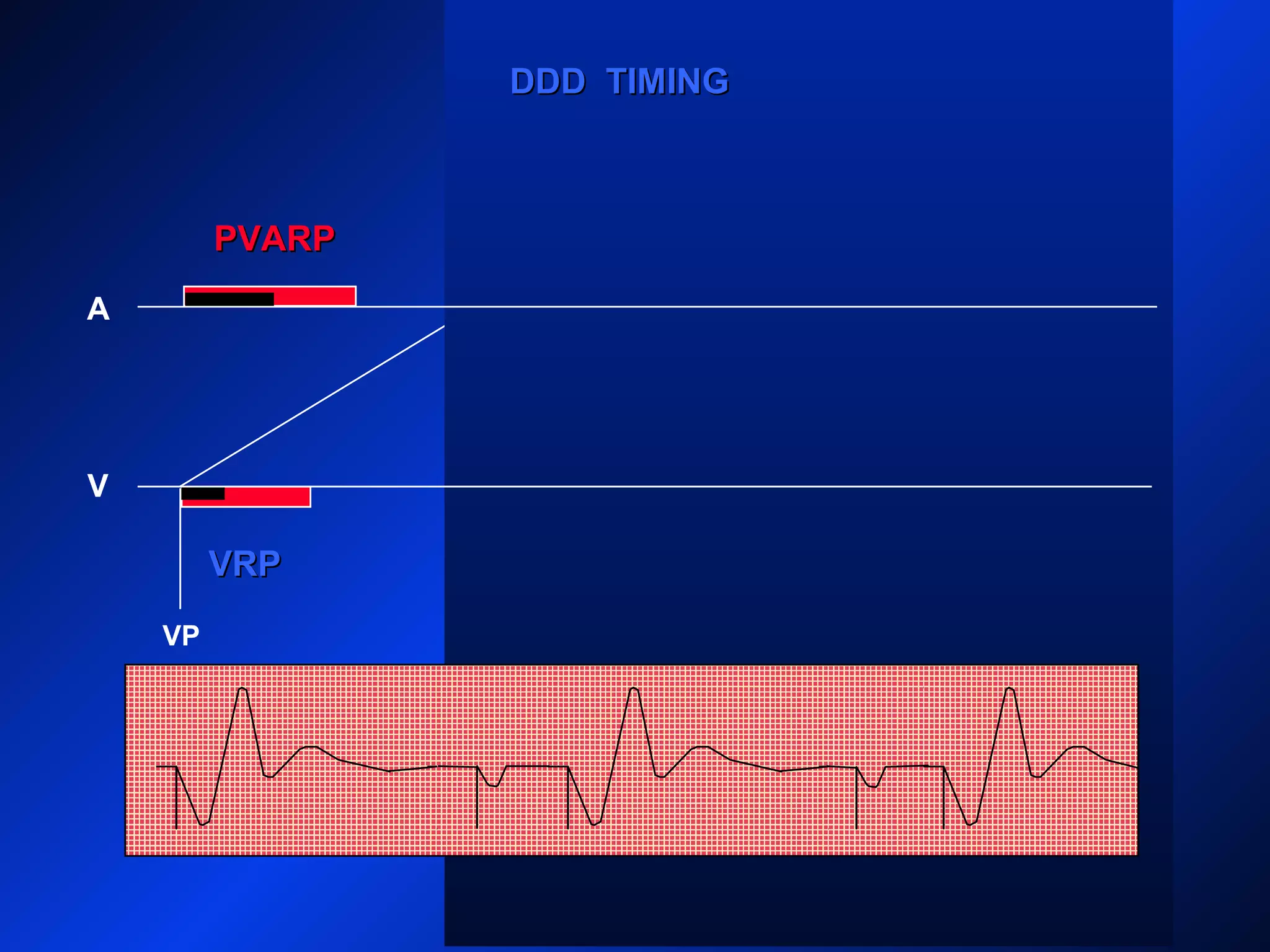 VP
A
V
PVARPPVARP
AP
VP
DDD TIMINGDDD TIMING
VRPVRP
PVARPPVARP
 