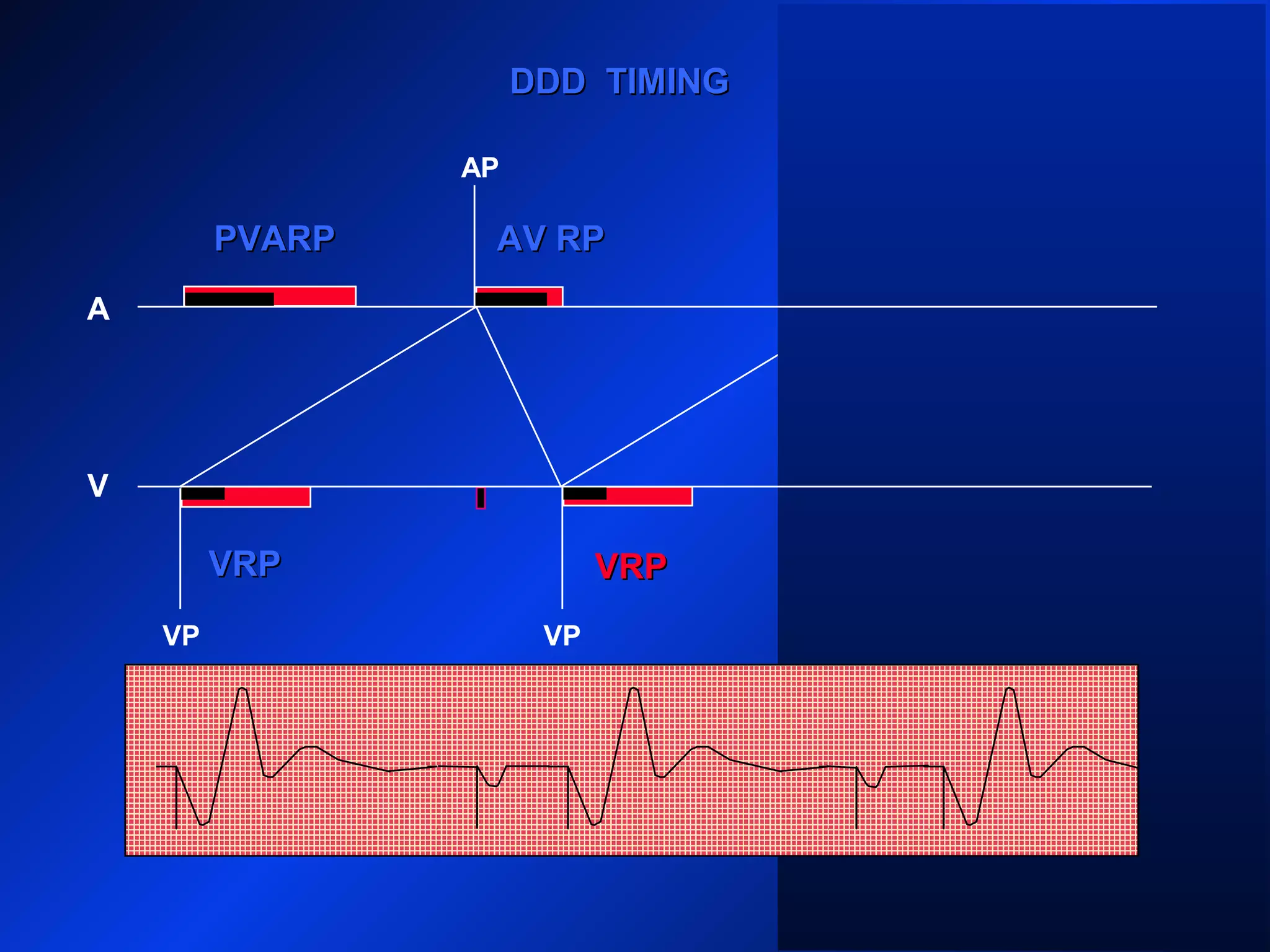 VP VP
AP
A
V
DDD TIMINGDDD TIMING
PVARPPVARP
VRPVRP
VP
AV RPAV RPPVARPPVARP
VRPVRP
 