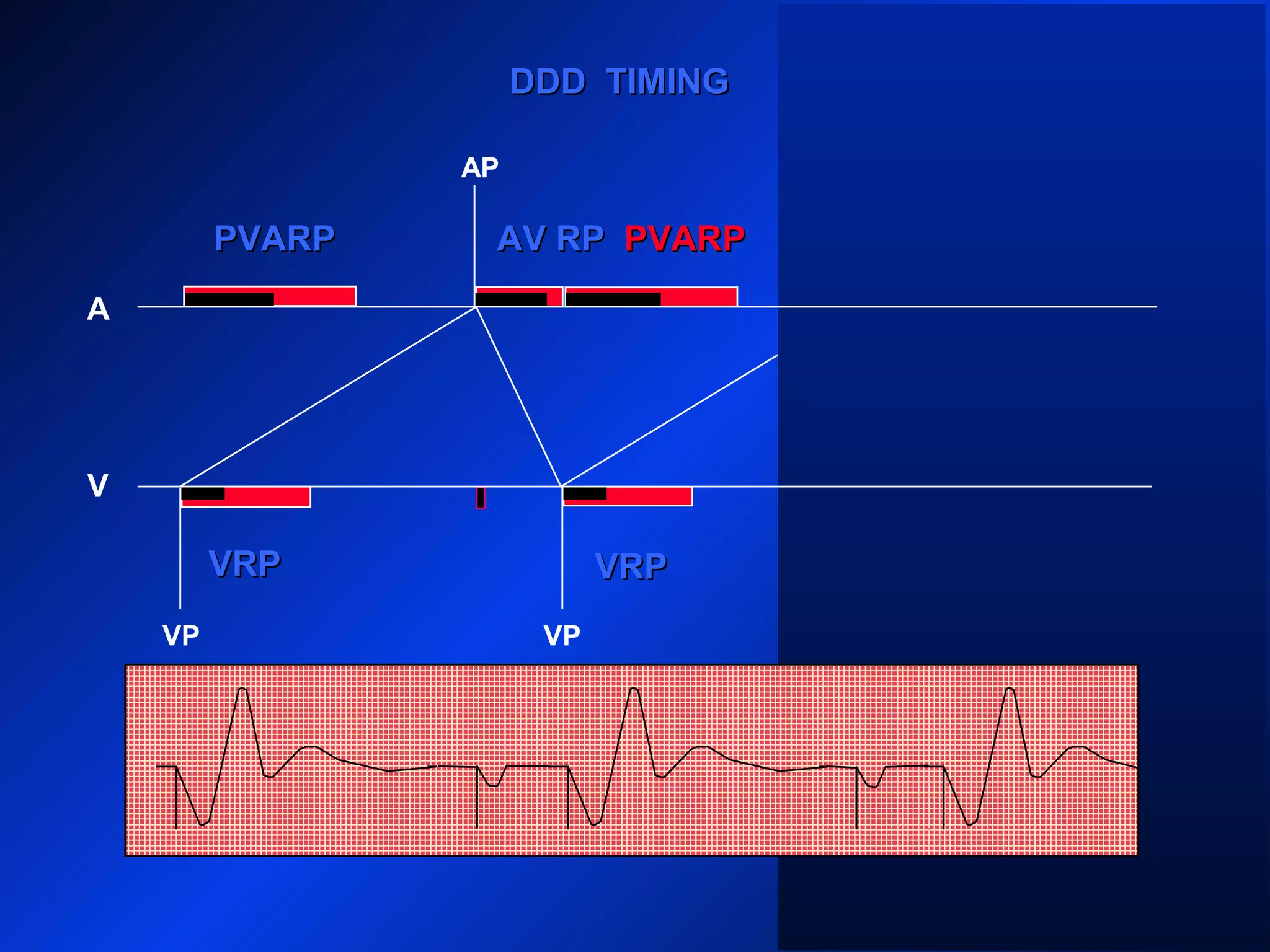 VP VP
AP
A
V
DDD TIMINGDDD TIMING
PVARPPVARP
VRPVRP
VP
AV RPAV RPPVARPPVARP PVARPPVARP
VRPVRP
 