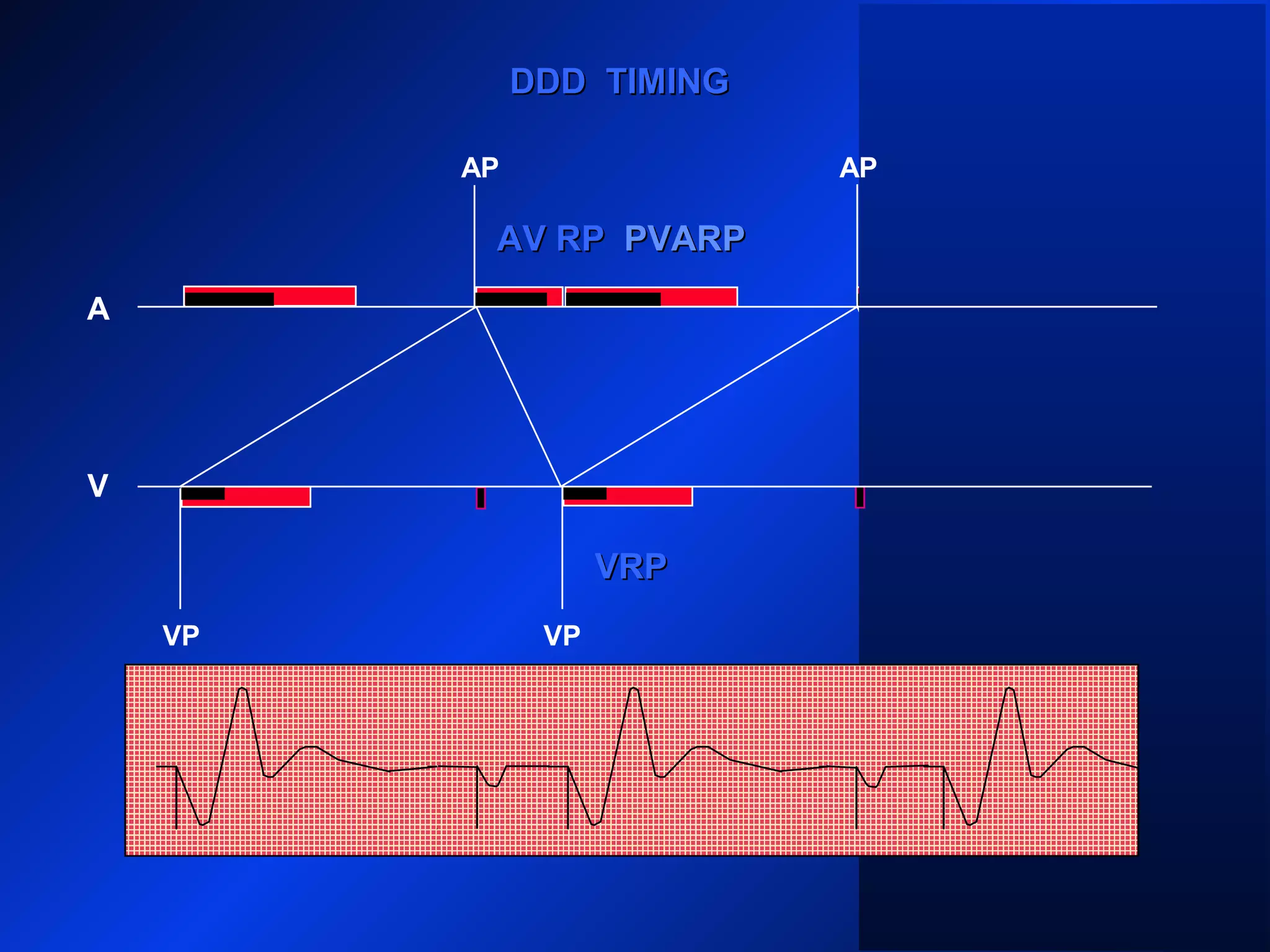 VP VP
AP
A
V
DDD TIMINGDDD TIMING
PVARPPVARPAV RPAV RP PVARPPVARP
VRPVRP
VP
AP
 