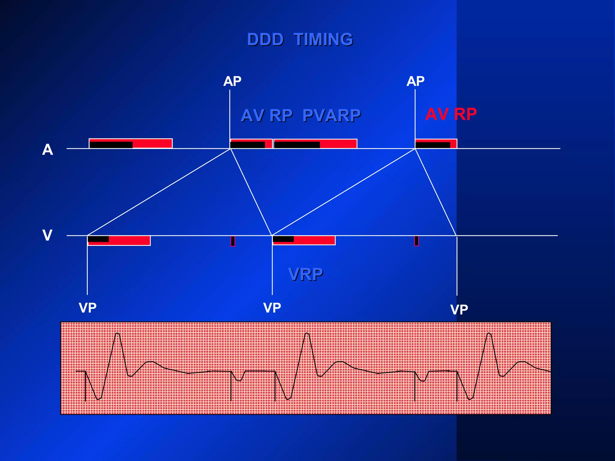 VP VP
AP AP
A
V
DDD TIMINGDDD TIMING
PVARPPVARPAV RPAV RP PVARPPVARP
VRPVRP
AV RP
VP
 