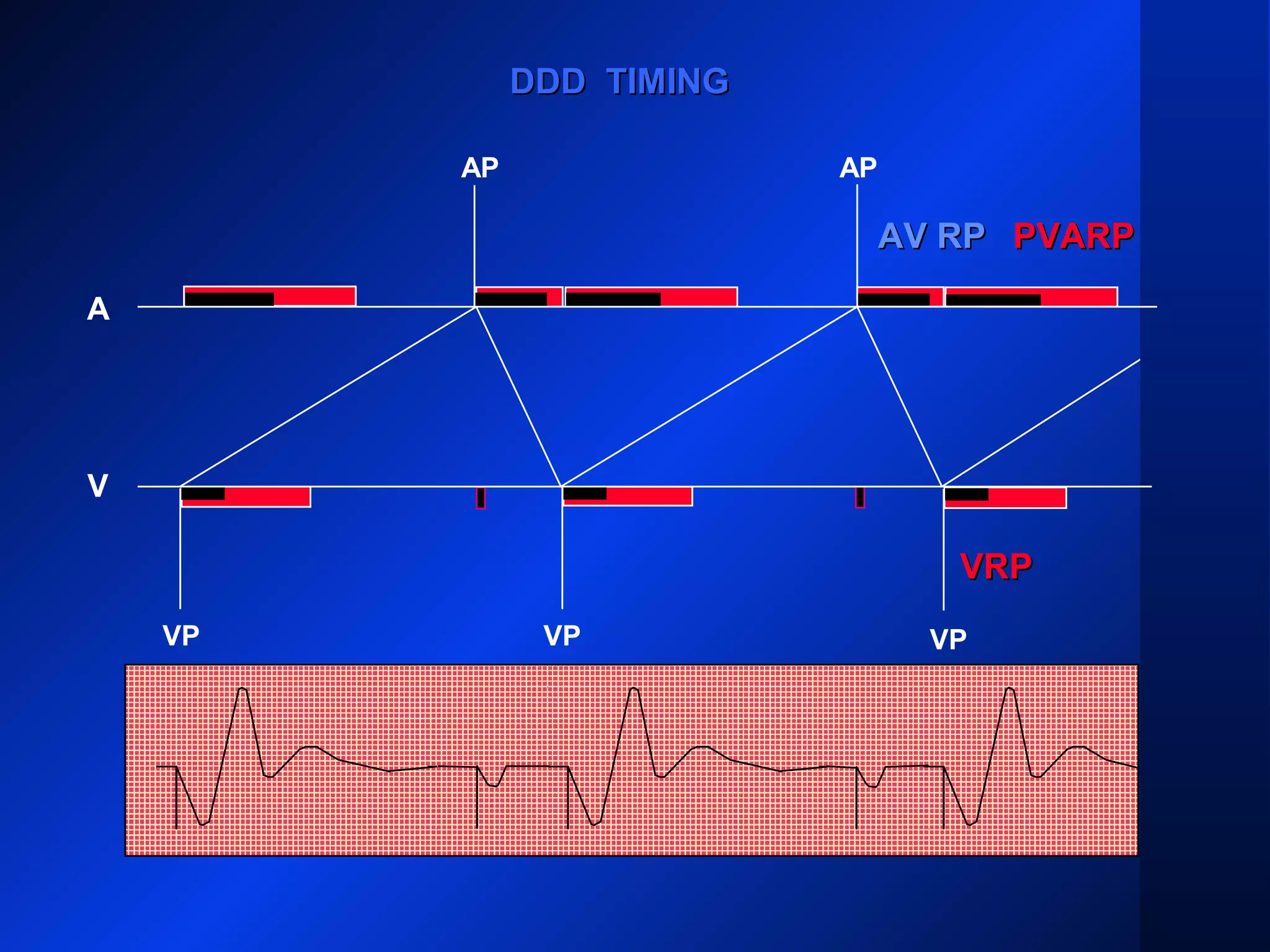 VP VP
AP AP
A
V
DDD TIMINGDDD TIMING
AV RPAV RP PVARPPVARP
VRPVRP
VP
 