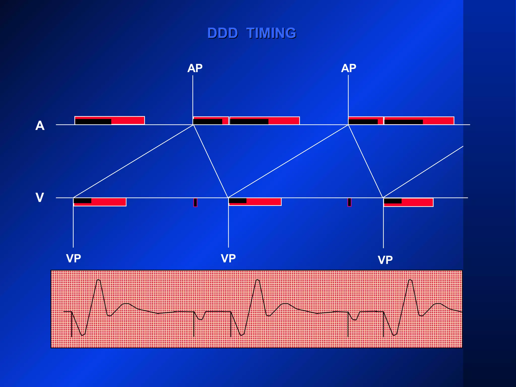 VP VP
AP AP
A
V
DDD TIMINGDDD TIMING
VP
 