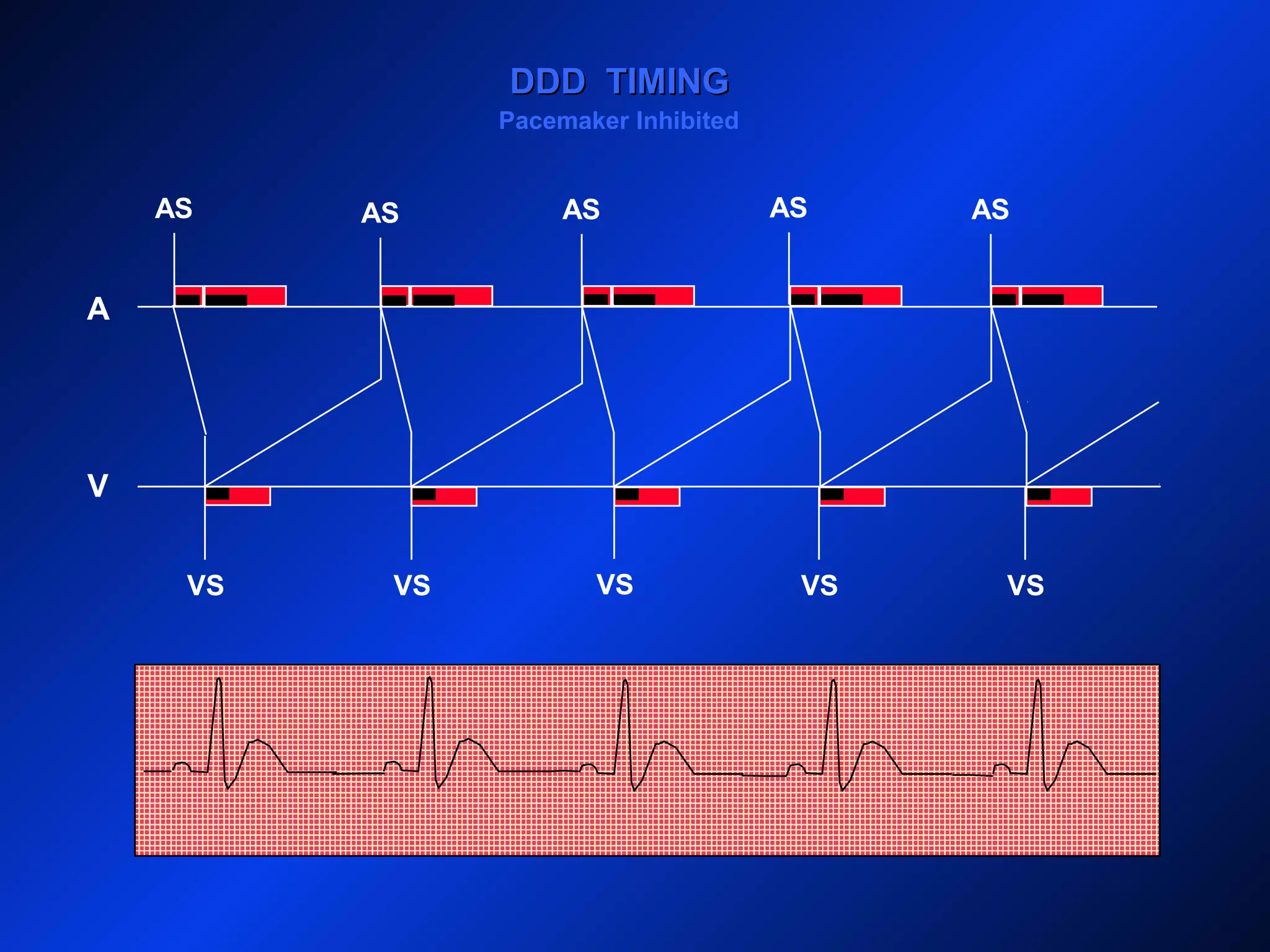 ASAS AS ASAS
DDD TIMINGDDD TIMING
VS VS VS VS VS
A
V
Pacemaker Inhibited
 