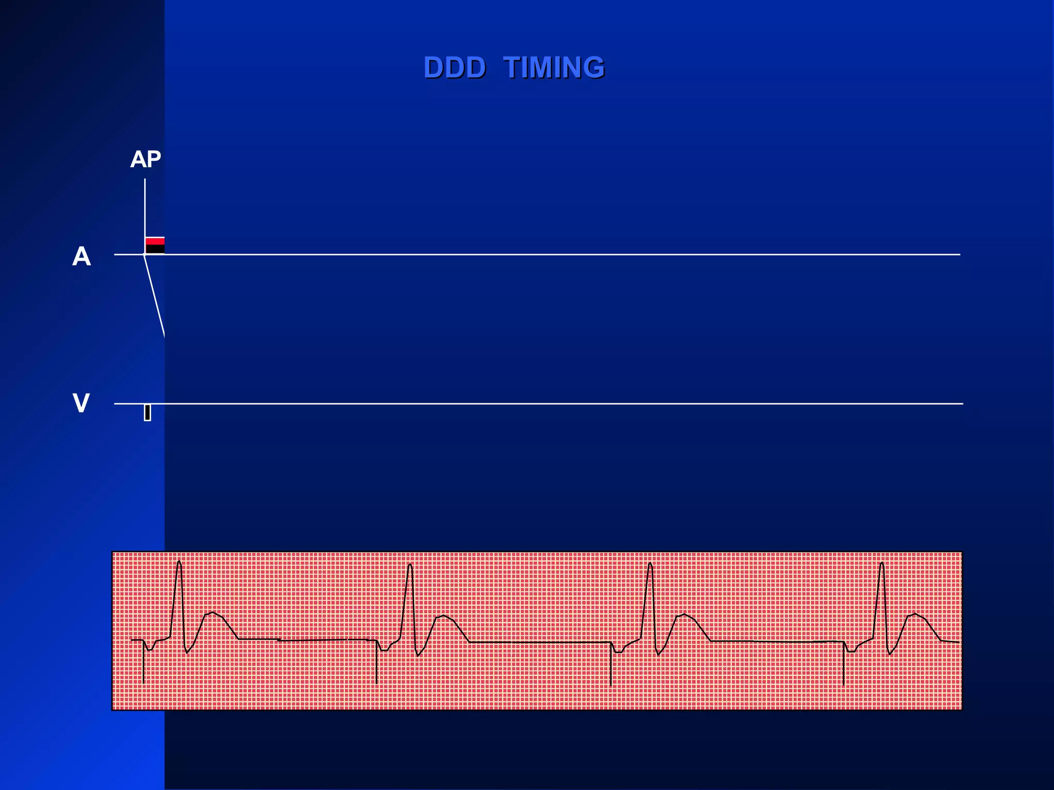 VS VS
AP AP AP
VS
AP
A
V
DDD TIMINGDDD TIMING
 