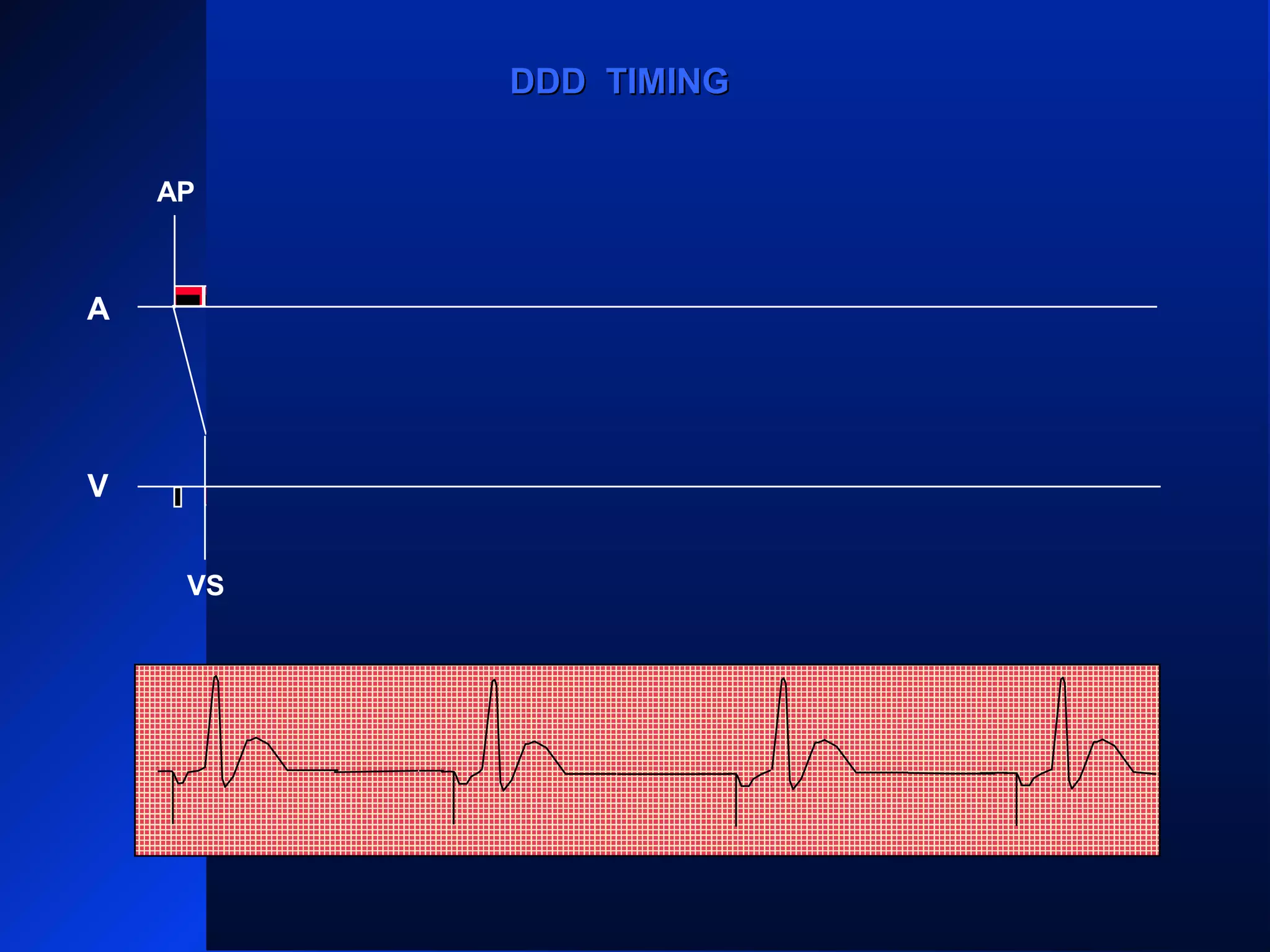 VS VS
AP AP AP
VS
AP
A
V
DDD TIMINGDDD TIMING
VS
 