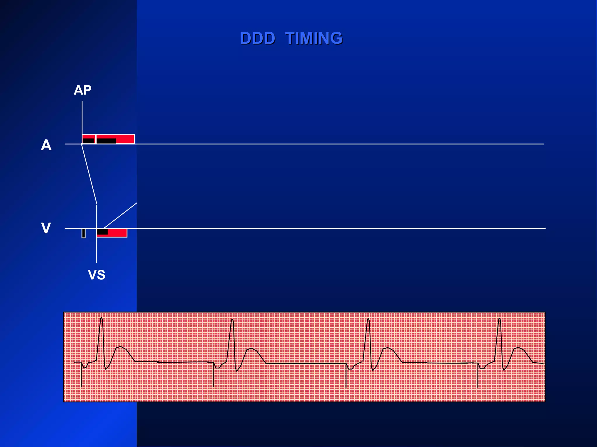 VS VS VS
AP AP AP
VS
AP
A
V
DDD TIMINGDDD TIMING
 