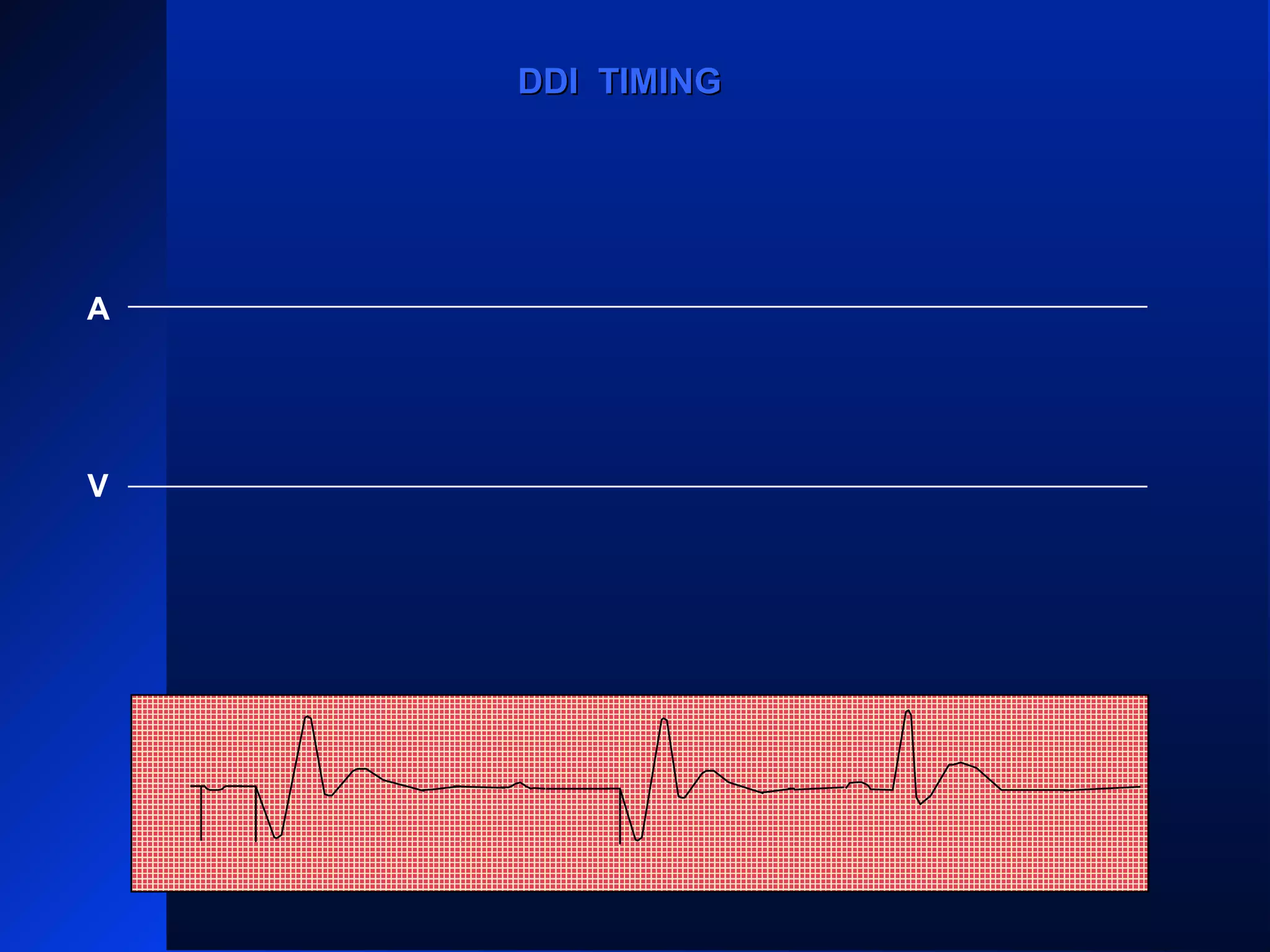 A
V
VS
PVARPPVARP
VRPVRP
ARP PVARPPVARP ARP PVARPPVARP
ARP
AS
VP
PVARPPVARP
AS
VP
ARPARPPVARPPVARP
AP
AV RPAV RP
DDI TIMINGDDI TIMING
 
