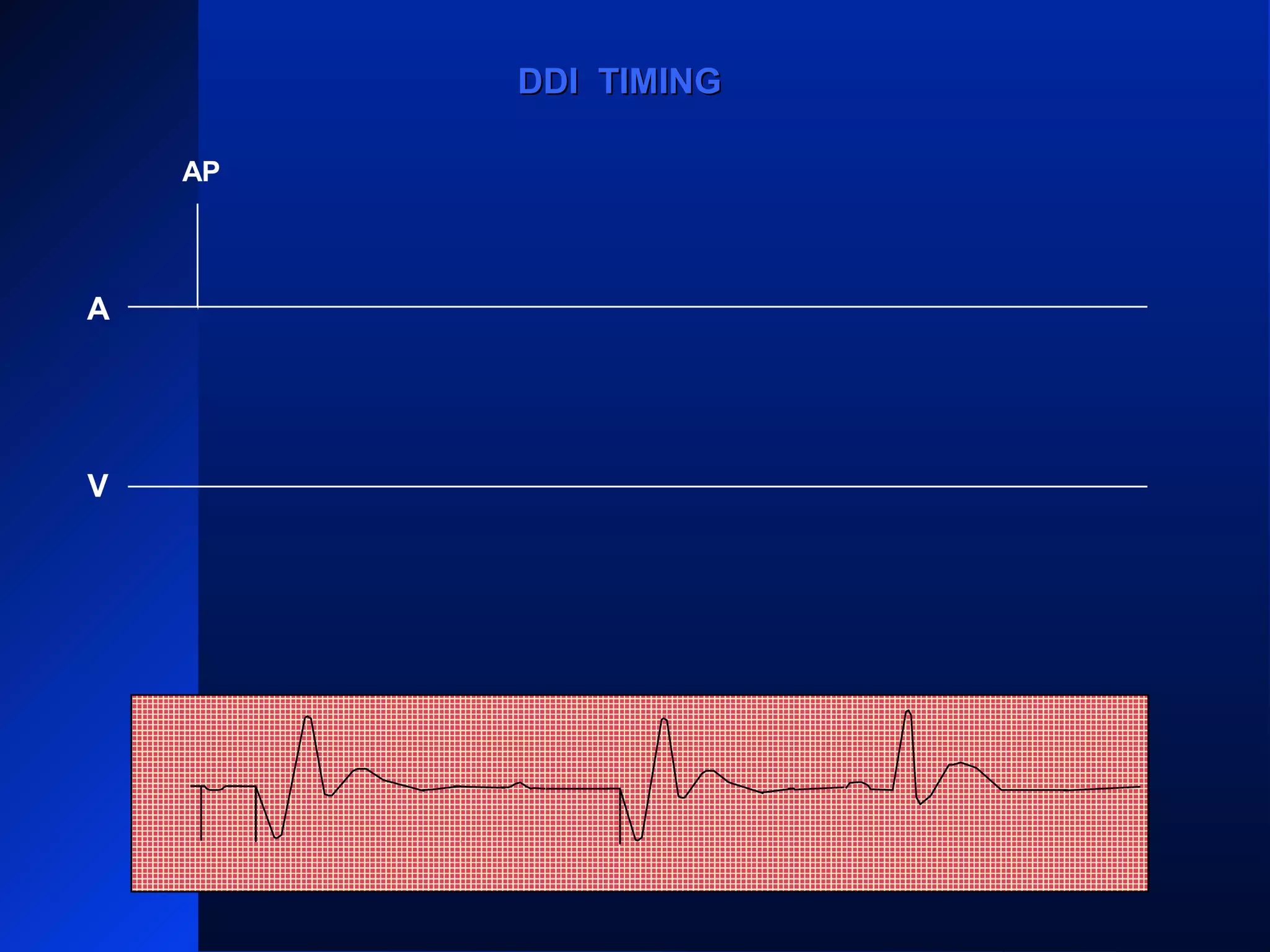 A
V
VS
PVARPPVARP
VRPVRP
ARP PVARPPVARP ARP PVARPPVARP
ARP
AS
VP
PVARPPVARP
AS
VP
ARPARPPVARPPVARPAV RPAV RP
AP
DDI TIMINGDDI TIMING
 