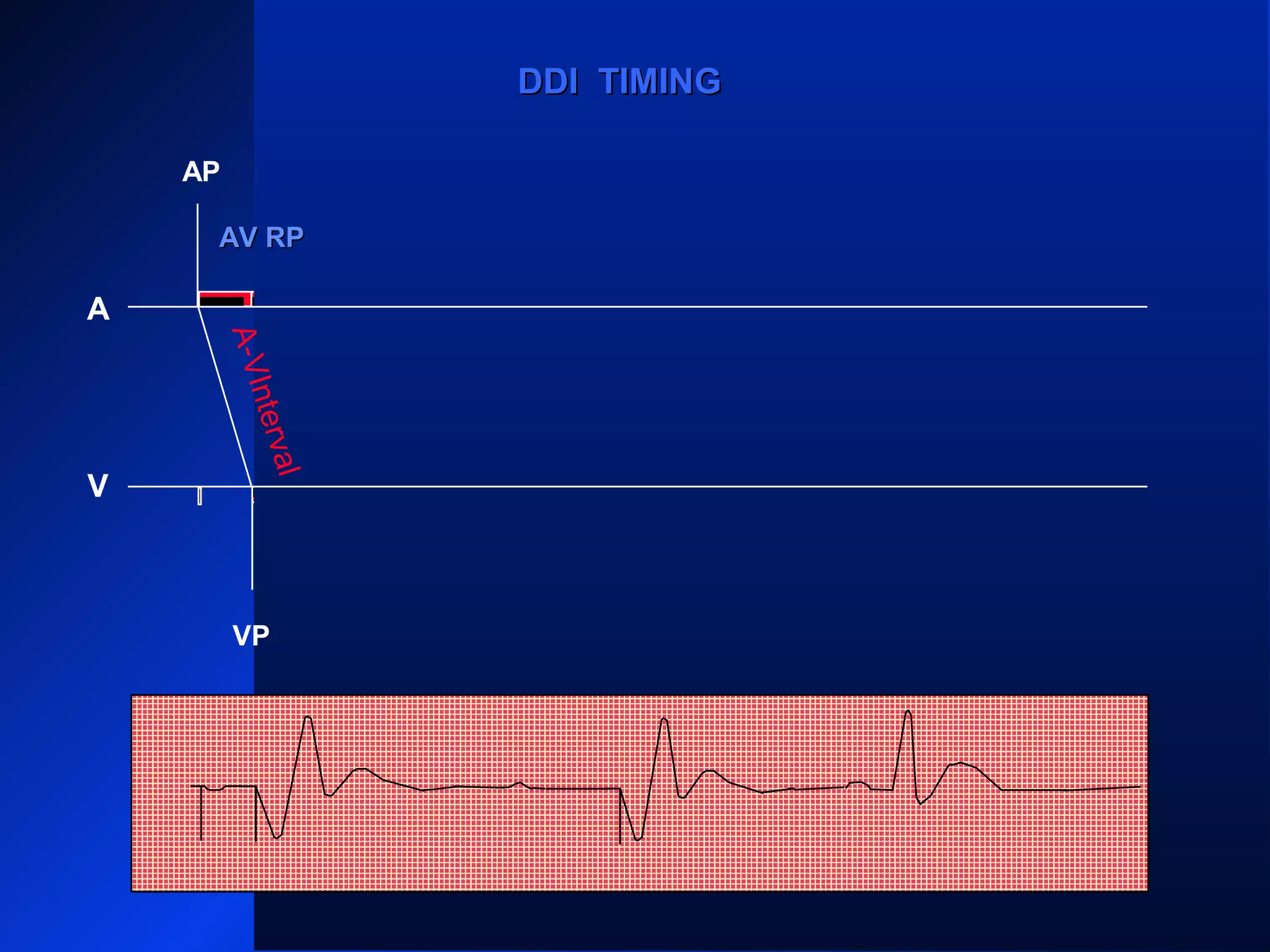 AP
A
V
VS
PVARPPVARP
VRPVRP
ARP PVARPPVARP ARP PVARPPVARP
ARP
AS
VP
PVARPPVARP
AS
ARPARPPVARPPVARP
VP
DDI TIMINGDDI TIMING
A-VInterval
AV RPAV RP
 