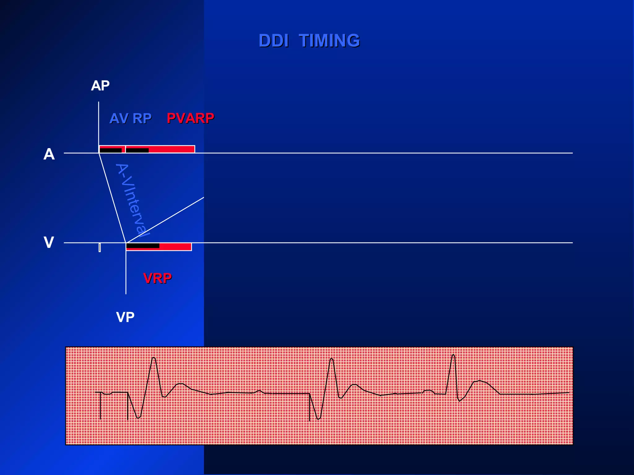 A-VInterval
AP
A
V
VP VS
VRPVRP
ARP PVARPPVARP ARP PVARPPVARP
ARP
AS
VP
PVARPPVARP
AS
ARPARP
DDI TIMINGDDI TIMING
AV RPAV RP PVARPPVARP
 