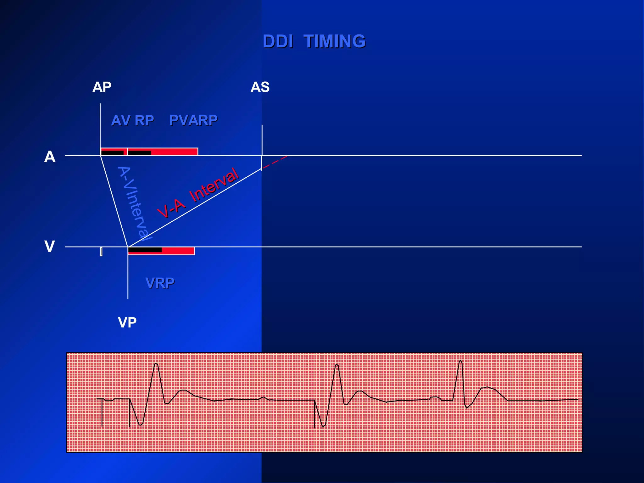 AP
A
V
VP VS
VRPVRP
ARP PVARPPVARP ARP PVARPPVARP
ARP
AS
VP
PVARPPVARPARPARP
AS
DDI TIMINGDDI TIMING
AV RPAV RP PVARPPVARP
A-VInterval
V-A
Interval
V-A
Interval
 