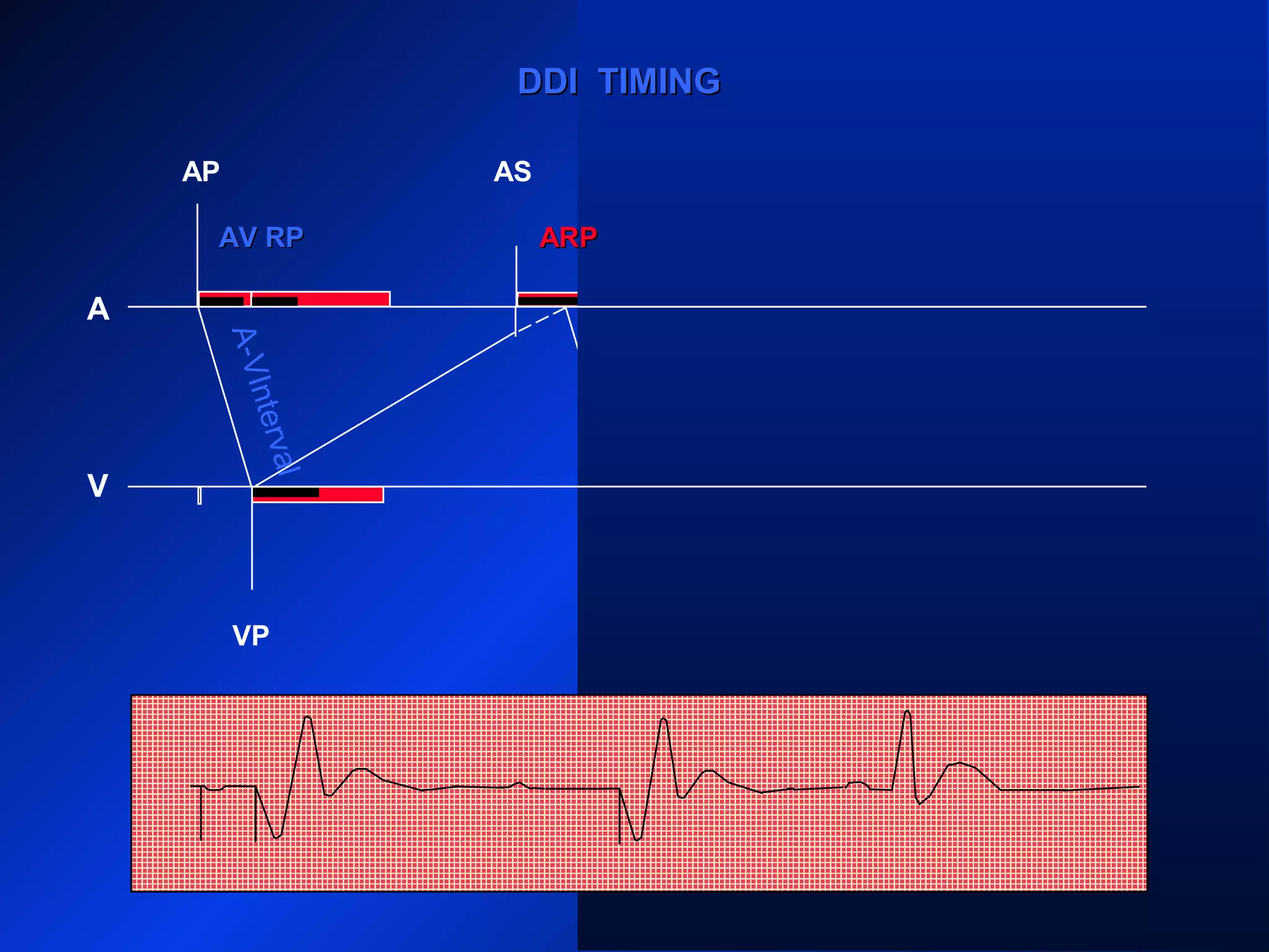 AP
A
V
AS
VP VS
PVARPPVARP ARP PVARPPVARP
ARP
AS
VP
PVARPPVARP
DDI TIMINGDDI TIMING
ARPARPAV RPAV RP
A-VInterval
 