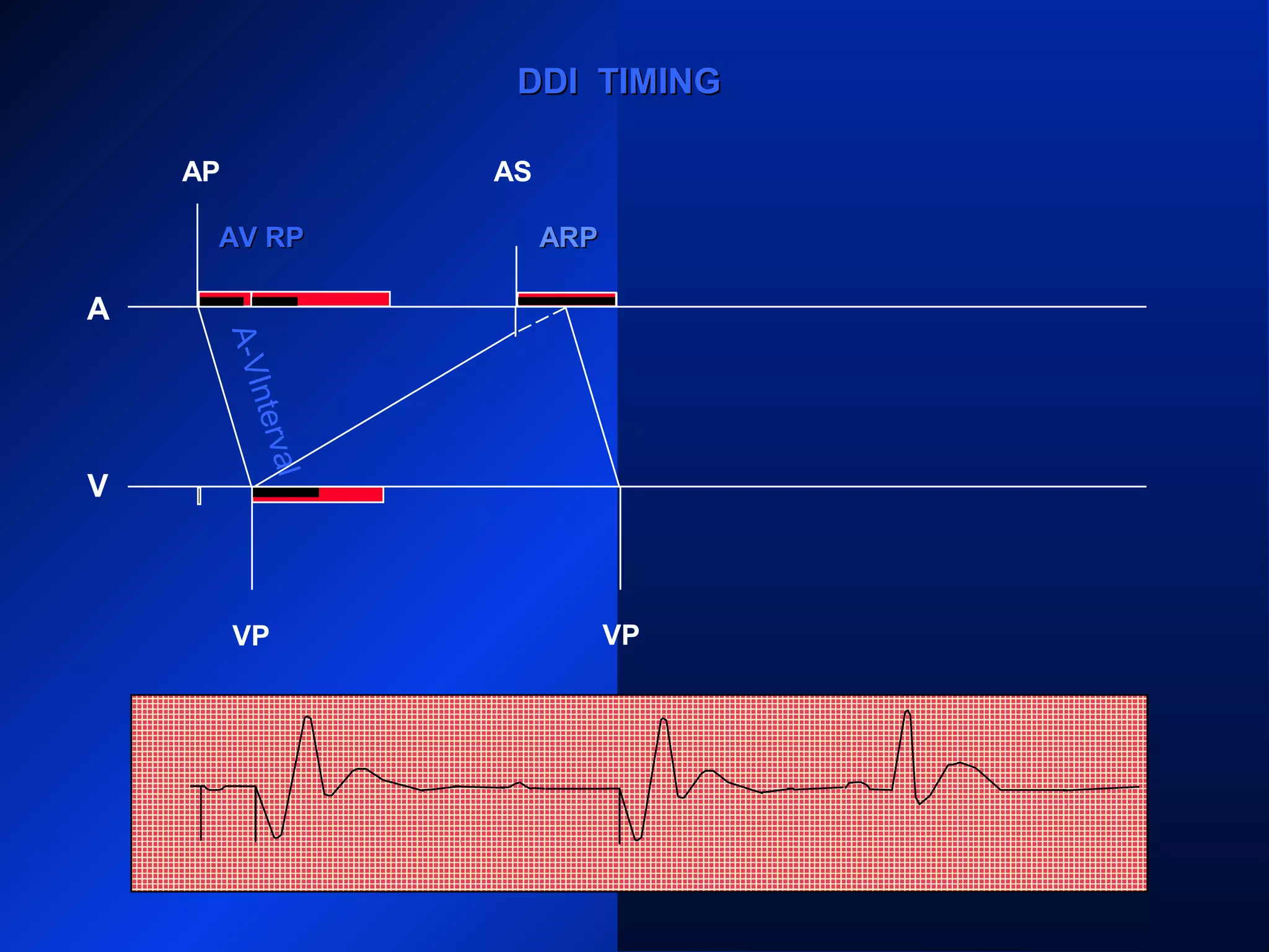 AP
A
V
AS
VP VS
PVARPPVARP ARP PVARPPVARP
ARP
AS
PVARPPVARP
DDI TIMINGDDI TIMING
VP
ARPARPAV RPAV RP
A-VInterval
 
