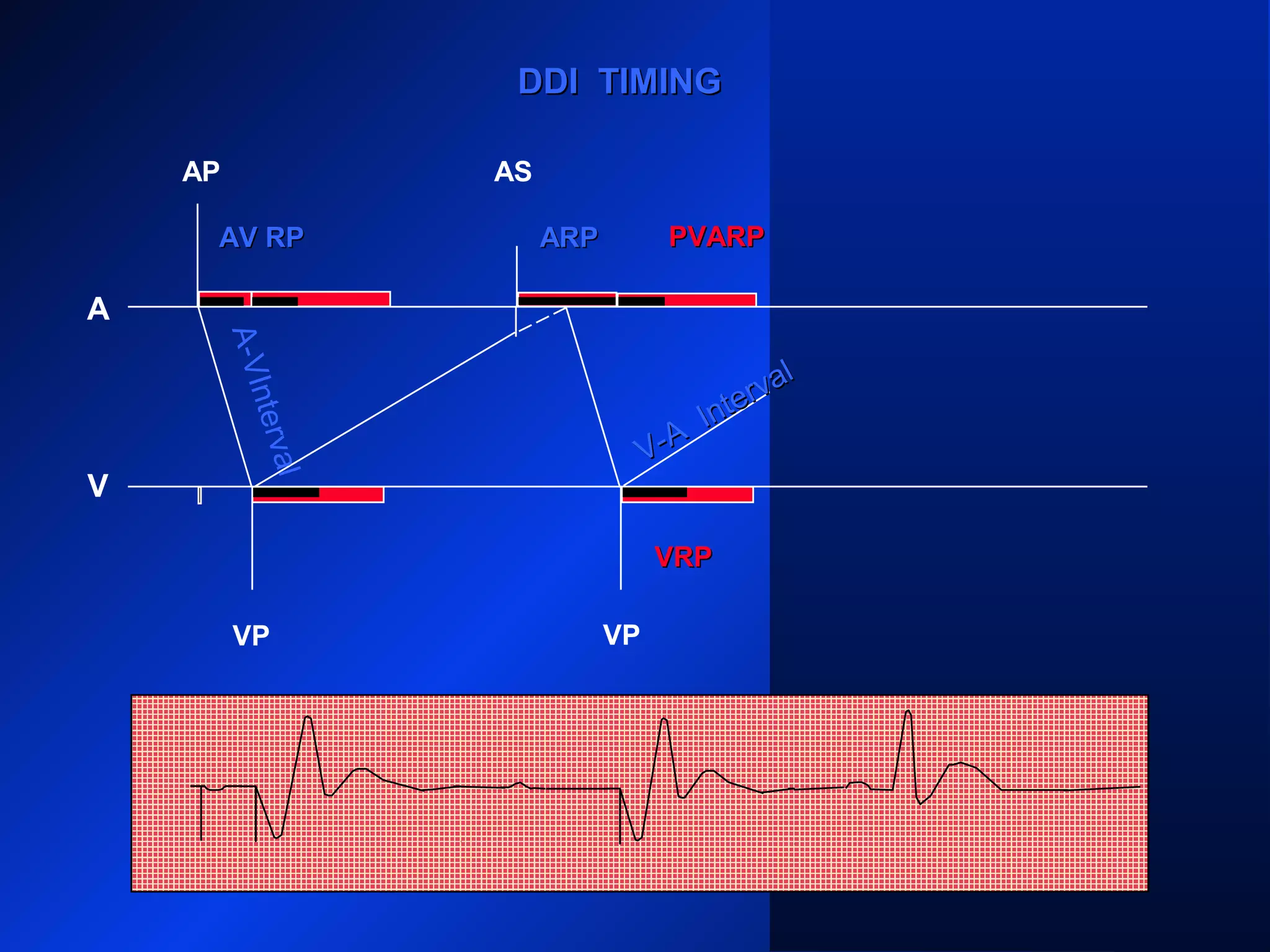 DDI TIMINGDDI TIMING
AP
A
V
AS AS
VP VP
ARPARP
A-VInterval
AV RPAV RP ARP
V-A
Interval
V-A
Interval
PVARPPVARP
VRPVRP
 