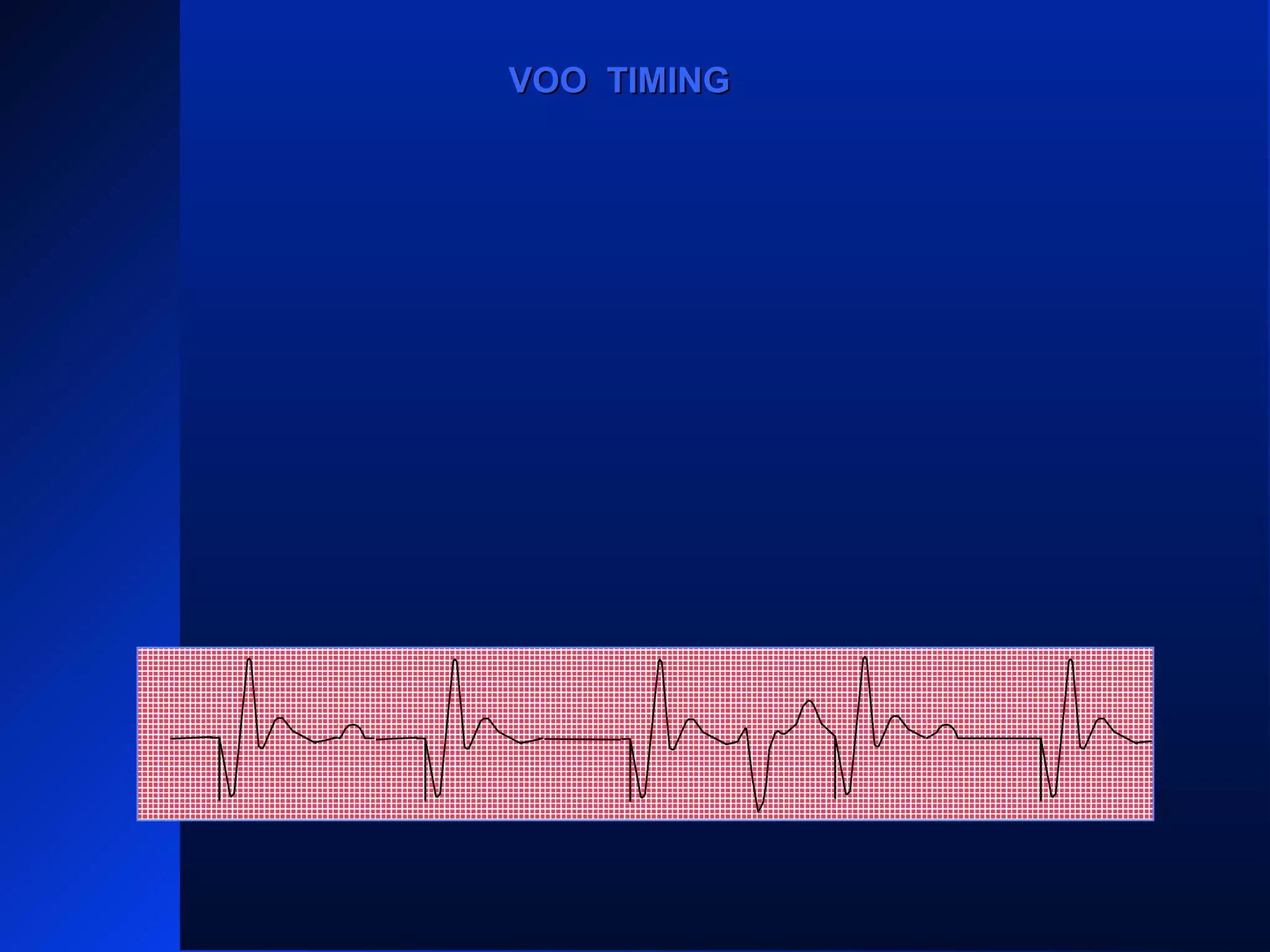 VPVPVP VP
VOO TIMINGVOO TIMING
 