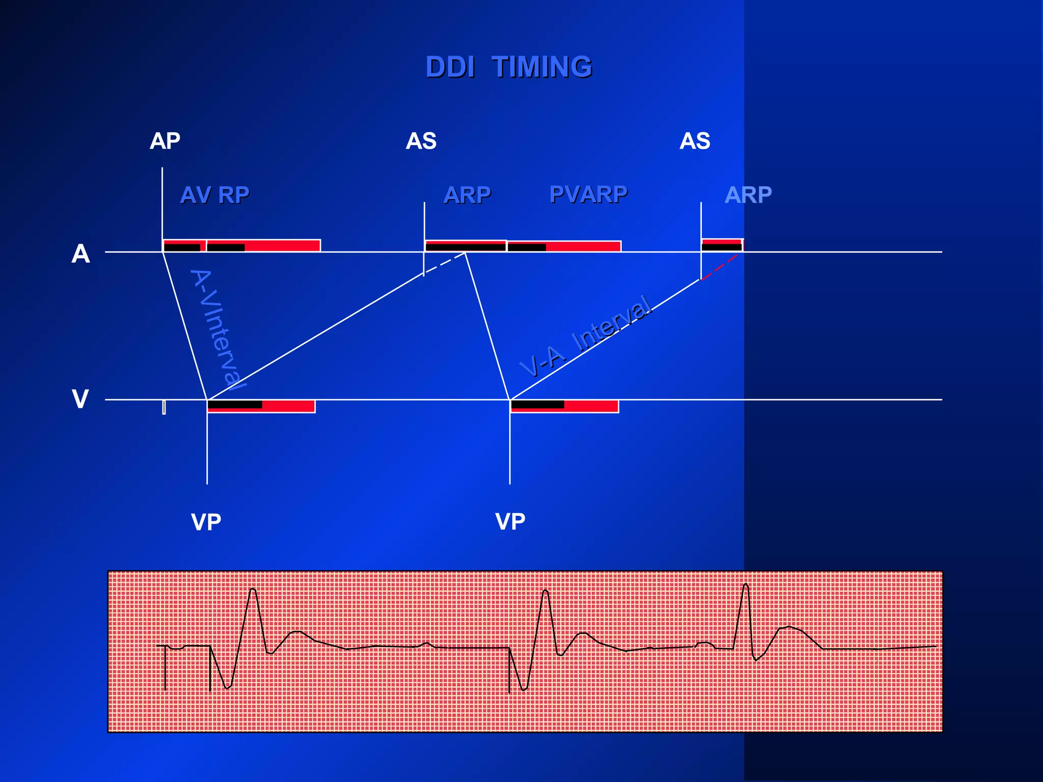 DDI TIMINGDDI TIMING
AP
A
V
AS AS
VP VP
ARPARPARP
A-VInterval
AV RPAV RP
V-A
Interval
V-A
Interval
PVARPPVARP
 