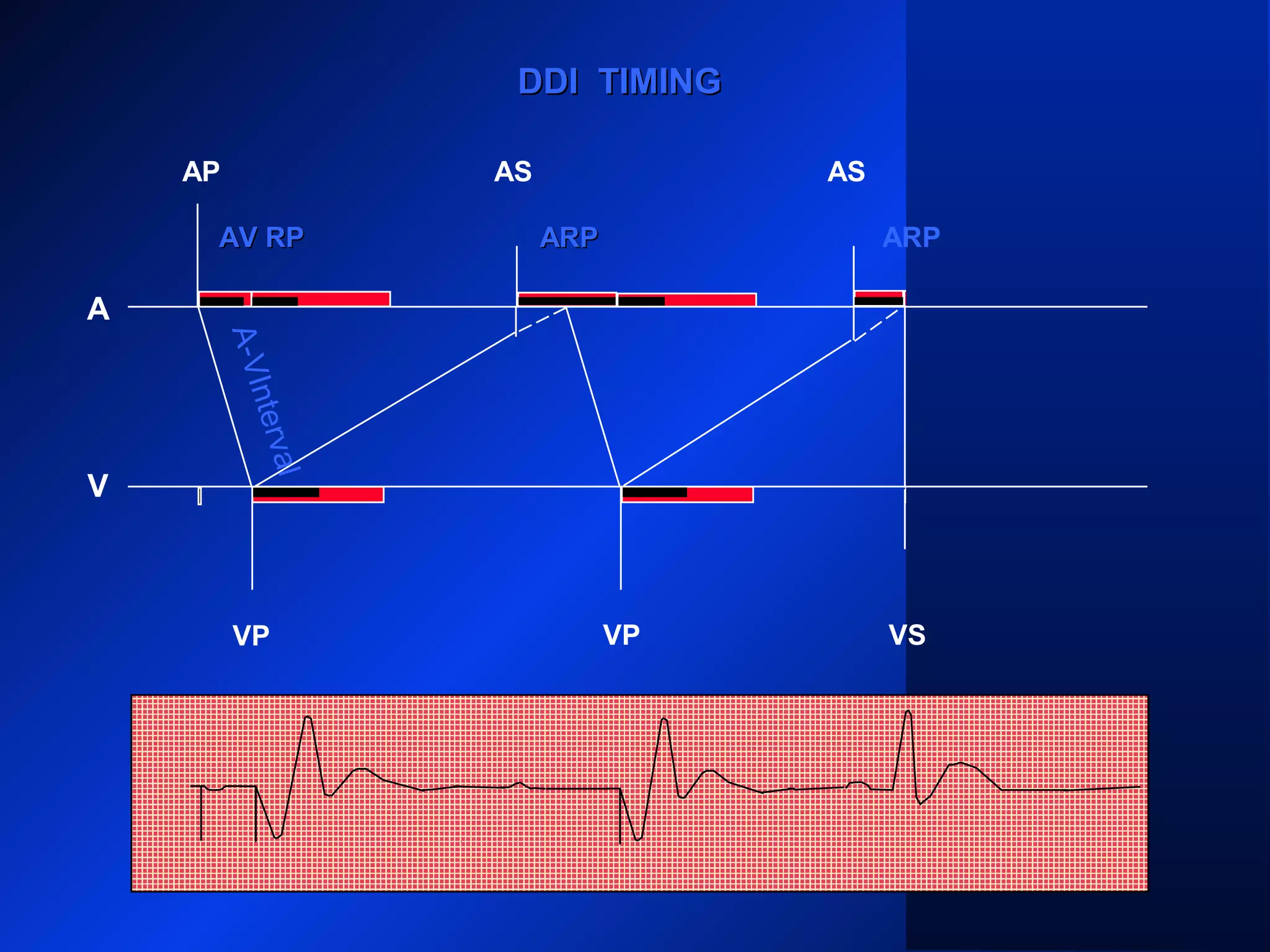DDI TIMINGDDI TIMING
AP
A
V
AS AS
VP VP VS
ARPARPARP
A-VInterval
AV RPAV RP
 