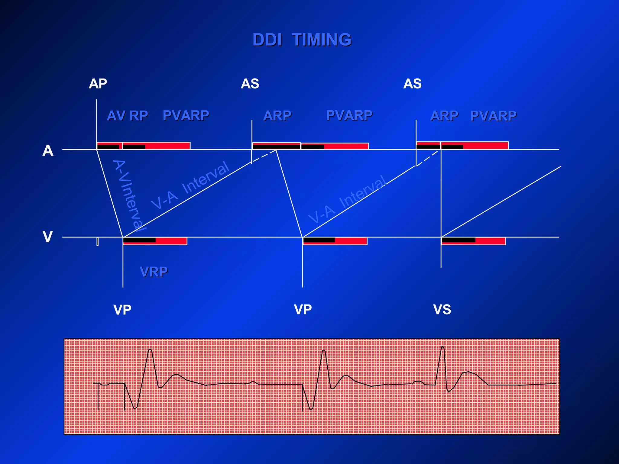 DDI TIMINGDDI TIMING
AP
A
V
AS AS
VP VP VS
ARPARPARPARPAV RPAV RP
A-VInterval
PVARPPVARPPVARPPVARP
V-A
Interval
PVARPPVARP
V-A
Interval
VRPVRP
 