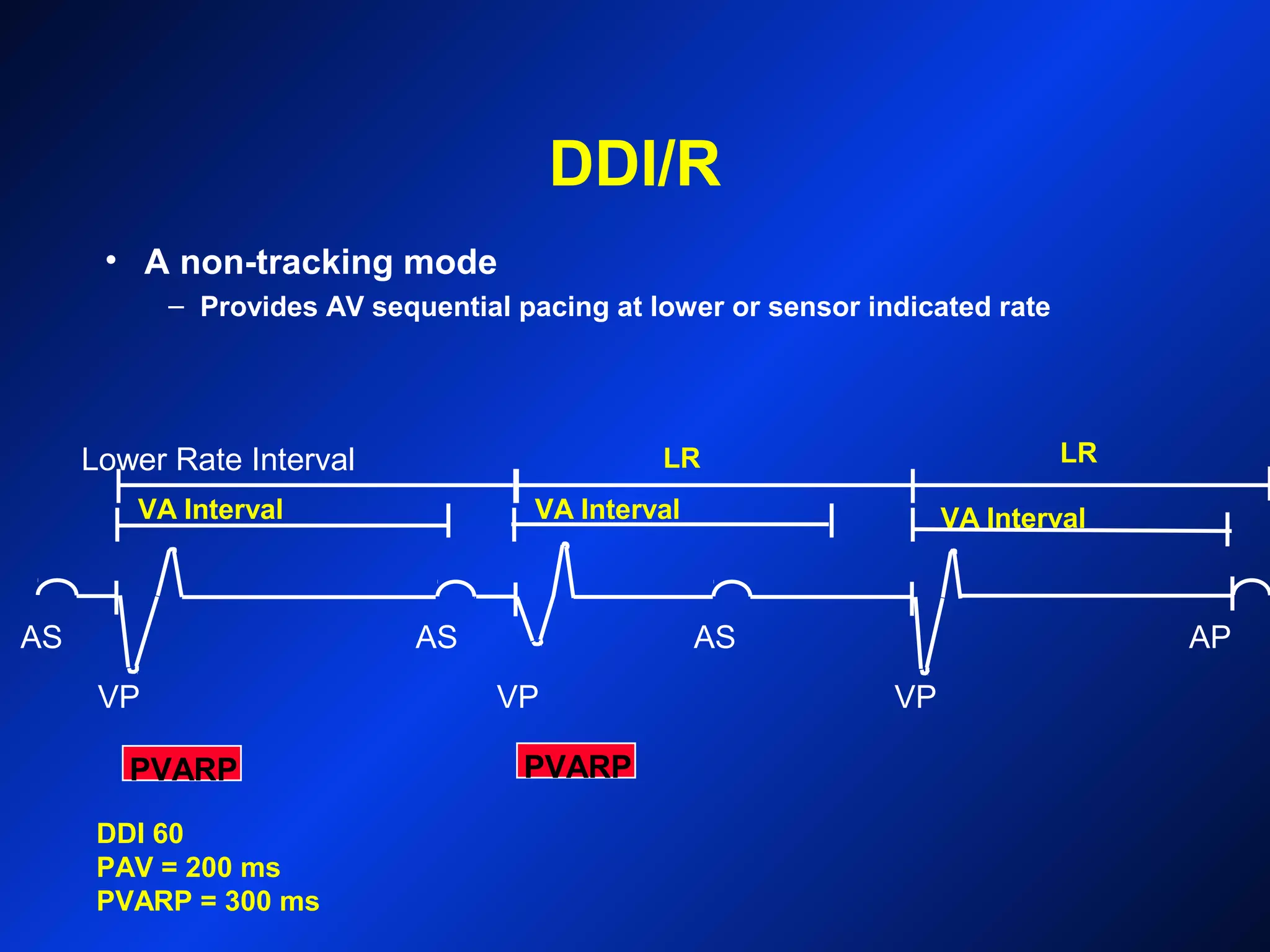 DDI/R
Lower Rate Interval
DDI 60
PAV = 200 ms
PVARP = 300 ms
VPVP VP
AS AS APAS
PVARP PVARP
• A non-tracking mode
– Provides AV sequential pacing at lower or sensor indicated rate
VA Interval VA Interval
LR LR
VA Interval
 