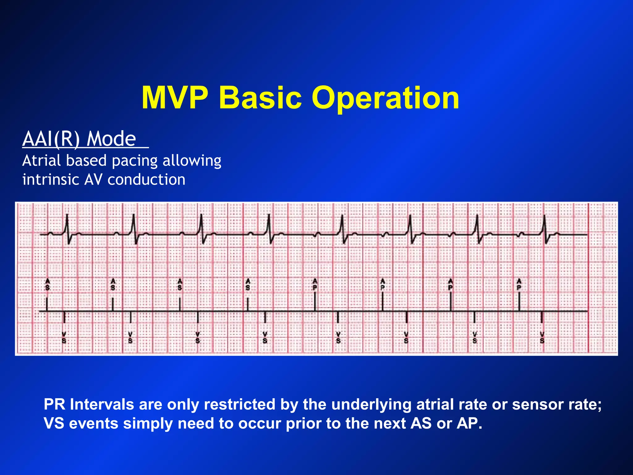 MVP Basic Operation
AAI(R) Mode
Atrial based pacing allowing
intrinsic AV conduction
PR Intervals are only restricted by the underlying atrial rate or sensor rate;
VS events simply need to occur prior to the next AS or AP.
 