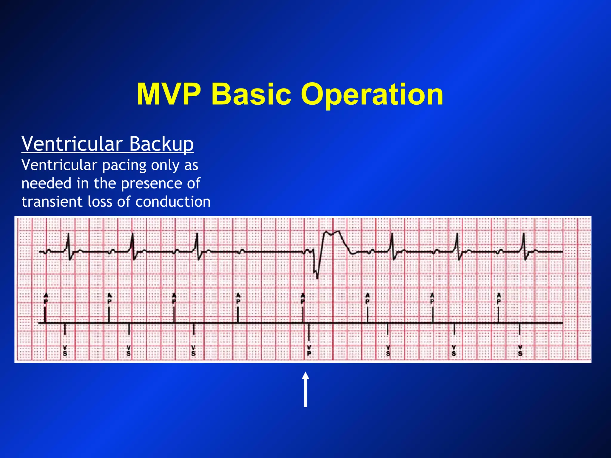 MVP Basic Operation
Ventricular Backup
Ventricular pacing only as
needed in the presence of
transient loss of conduction
 